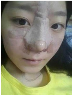 上海時光整形外科醫(yī)院做耳軟骨隆鼻術后剛剛結束