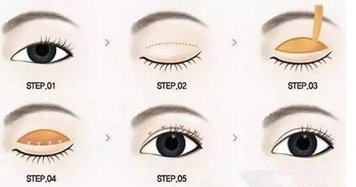 哈爾濱第一醫(yī)院切開雙眼皮多少錢？切開雙眼皮如何恢復(fù)？