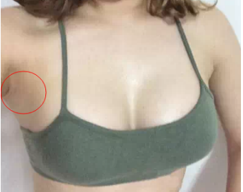 南京美貝爾醫(yī)療美容醫(yī)院做假體隆胸手術(shù)后的一個月