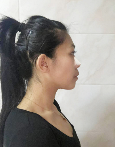 深圳恩吉娜醫(yī)療美容門診部做鼻綜合剛剛做完手術(shù)后