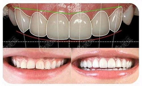 池州博雅口腔全瓷牙有何優(yōu)點(diǎn)？全瓷牙與烤瓷牙有何區(qū)別？
