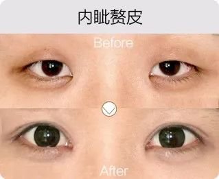 哈爾濱成美整形內(nèi)眥贅皮矯正怎么樣有哪幾種手術(shù)方法？