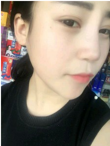 上海時光整形外科醫(yī)院做耳軟骨隆鼻術后自然的鼻子