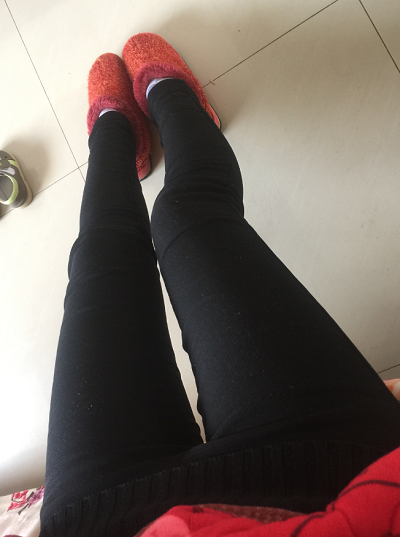 蘇州圣愛(ài)醫(yī)院醫(yī)療美容科做大腿吸脂手術(shù)后的日常