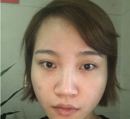 上海時光整形外科醫(yī)院做鼻綜合手術(shù)前